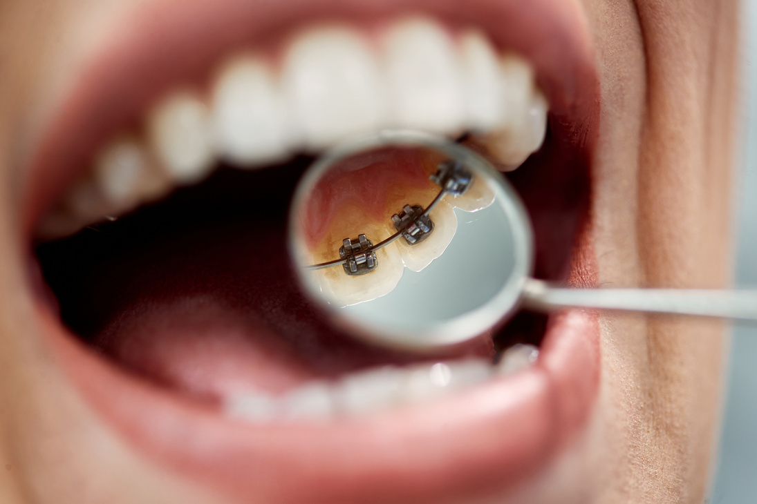 Close-up of woman having lingual braces check-up by orthodontist at dentist's office.