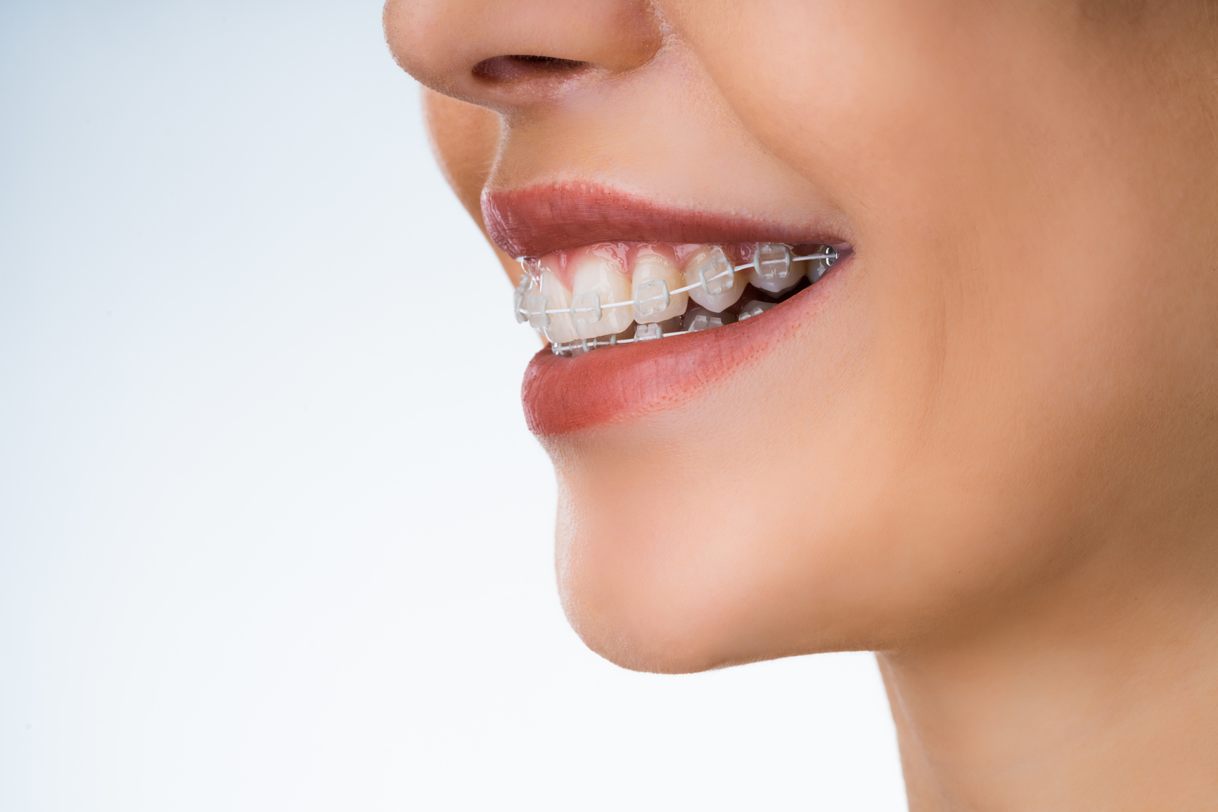 Female Mouth With Metal White Dental Braces