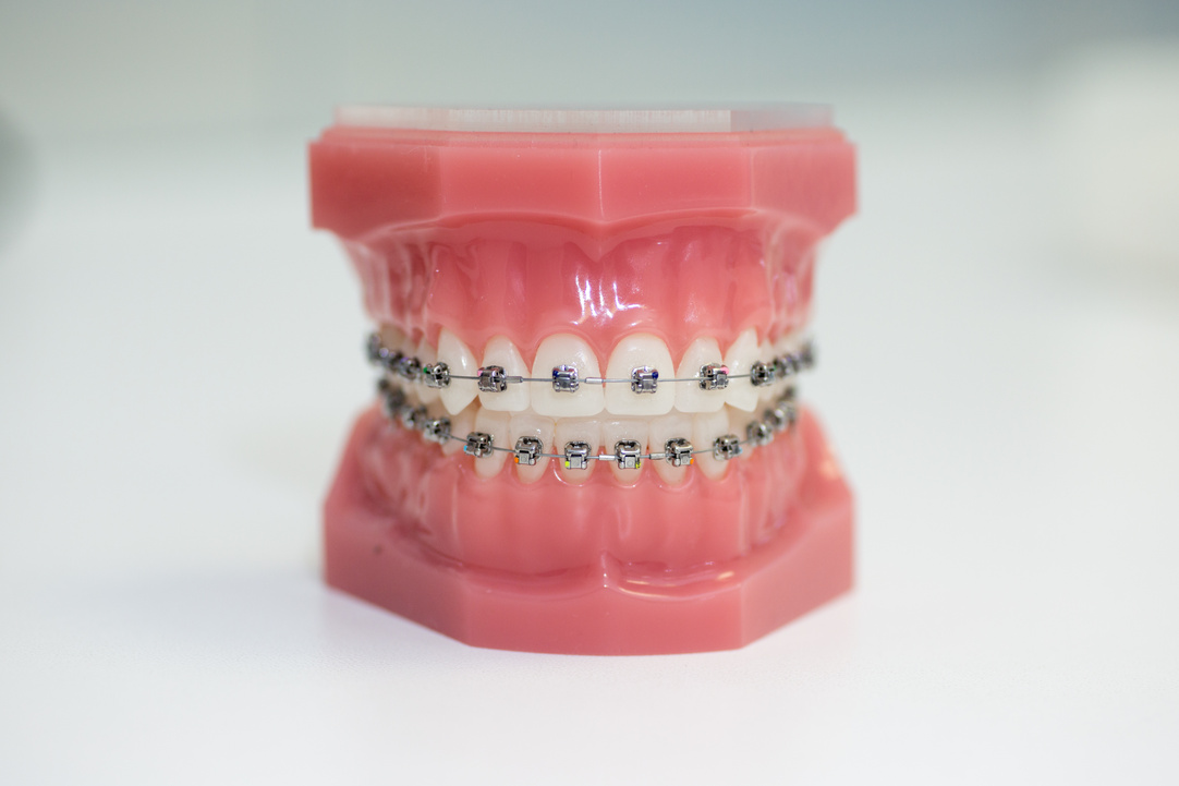Orthodontic Model, Metal Brace